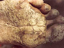 Arsenicosis at feet; scattered wart- or tumorlike nodi on the sole; toes also are affected; the patient suffers disorder in the blood circulation of toes (© China Medical University, Shenyang) 